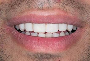 Watson Pointe Dental | Laser Dentistry, Dental Fillings and Teeth Whitening