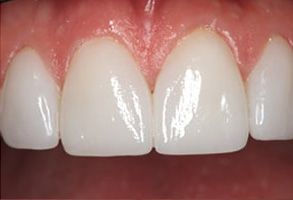 Watson Pointe Dental | Teeth Whitening, Periodontal Treatment and Veneers